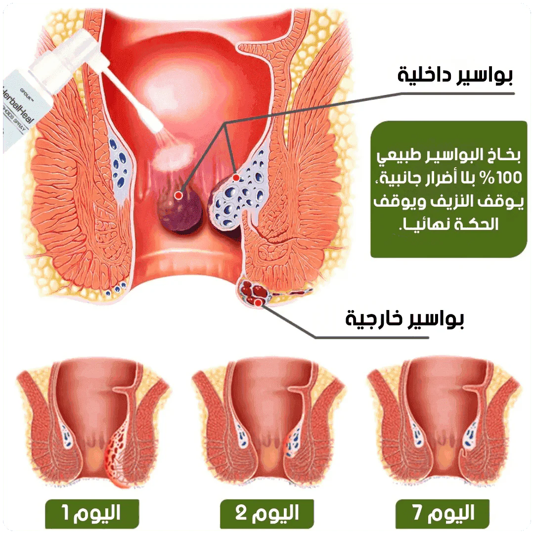 HerbalHeal - بخاخ عشبي لعلاج البواسير